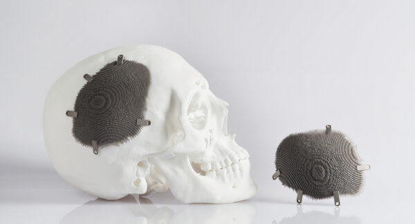 3d printing implantation of bones
